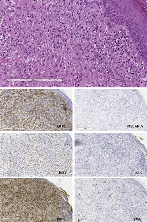 Dermatoscopy Of Cellular Neurothekeoma Jaad Case Reports