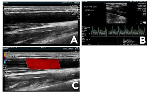 Ultrasound modes used for vascular access examination. A) B-mode ...