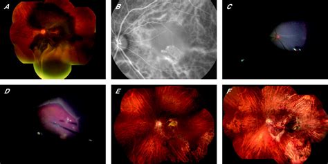 Pars Plana Vitrectomy With Peripheral Retinotomy After Injection Of