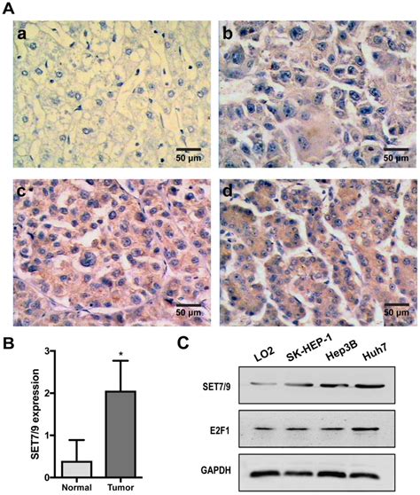 Set Promotes Hepatocellular Carcinoma Progression Through Regulation