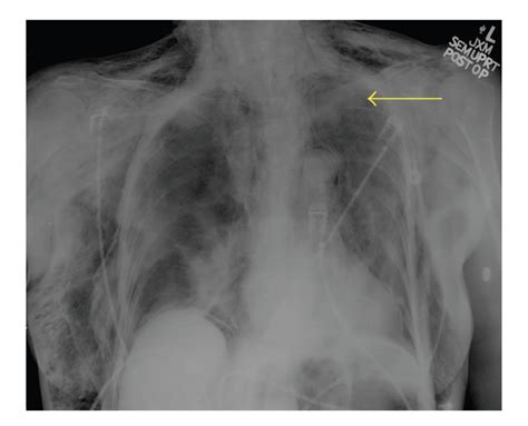 Portable chest X-ray showing subcutaneous emphysema, pneumomediastinum ...