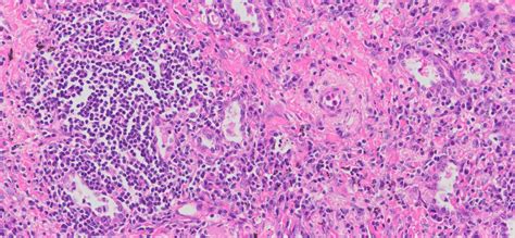 Human Lung Tissue Chronic Inflammation FFPE Sections