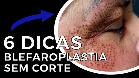 Pin On Blafaroplastia Se Corte