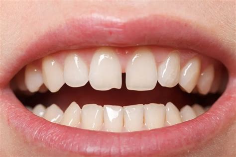 Zahnlücke schließen Methoden und Möglichkeiten ilovemysmile