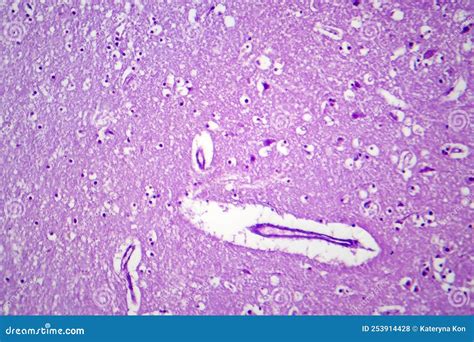 Histopathology Of Japanese Encephalitis Light Micrograph Royalty Free