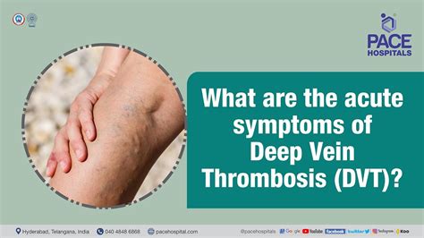 What Are The Acute Symptoms Of Deep Vein Thrombosis Dvt Pace Hospitals Shortvideo Dvt