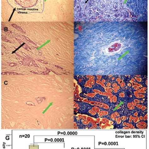 The Difference Of Sma Expression In Invasive Breast Cancer Normal