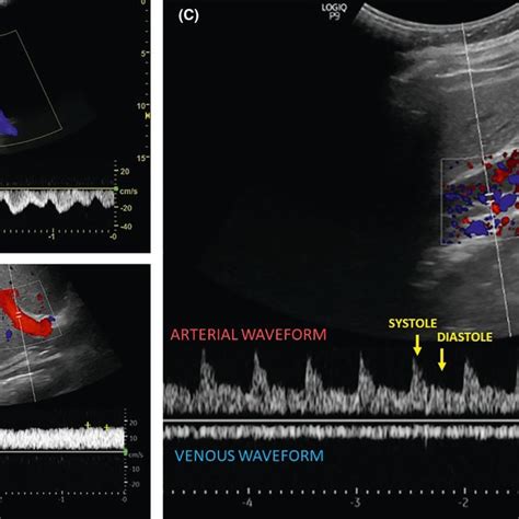 Inferior Vena Cava Ultrasound And Venous Doppler Patterns From The