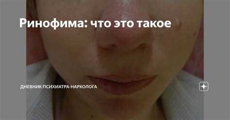 Ринофима: что это такое | Нарколог Калюжная Марина | Дневник психиатра ...