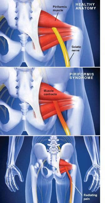 Piriformis Syndrome Sarasota Fl Schofield Hand And Bright Orthopaedics