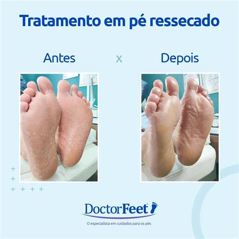 O Que Causa Ressecamento Nos Pés - ⚠️O ressecamento dos pés é... - Doctor Feet Estação Cuiabá
