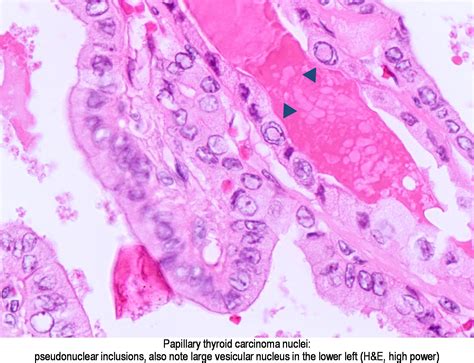 Pathology Outlines Papillary Thyroid Carcinoma Overview