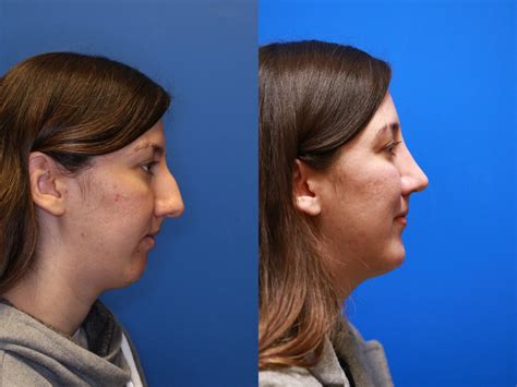 Nose Surgery Before & After Photos Patient 282 | San Francisco, CA ...