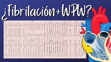 El Paciente con Fibrilación Auricular y Wolff Parkinson White YouTube