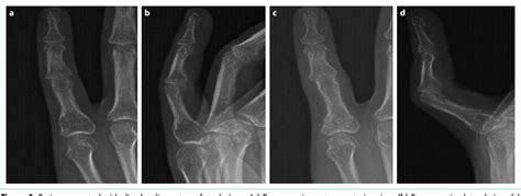 Figure From Comparison Of Distal Radius Autograft Technique With