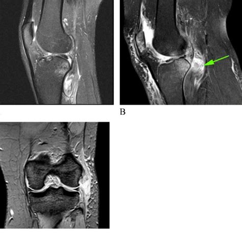 Coronal Pdfs B Shows Injury Of The Popliteofibular Ligament At Site