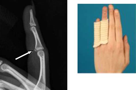 Xhand Startradiology In Hand Injuries Avulsion