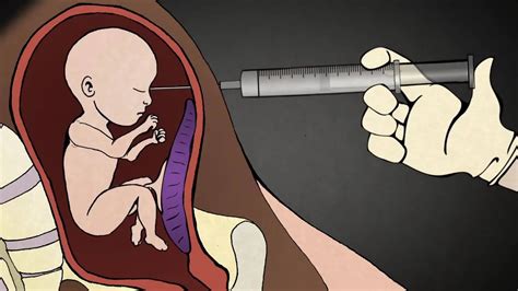 Aborto Inducido En El Er Trimestre Injeccion Y Nacimiento Muerto