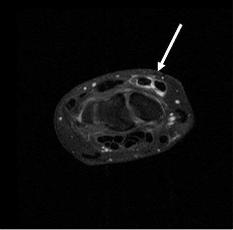 Mri Showing An Isolated Tenosynovitis Of The Ecrb And Ecrl Tendons The Download Scientific