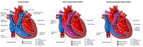 Congenital Heart Disease: Hole In The Heart