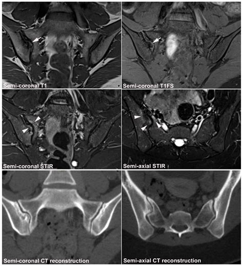 Sacroiliac Joint Dysfunction Mri