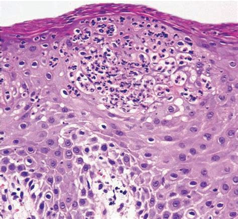 Noninfectious Erythematous Papular And Squamous Diseases Plastic