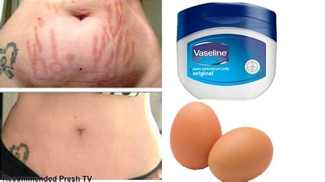 World S Best Remedy For Stretch Mark Removing How To Get Rid Of Stretch Marks Fast Using