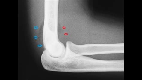 Arthrocentesis Of The Elbow Joint Internet Book Of Msk Ultrasound