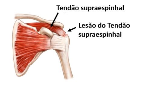 Ruptura Do Tend O Supraespinhal Diagn Stico Tratamento