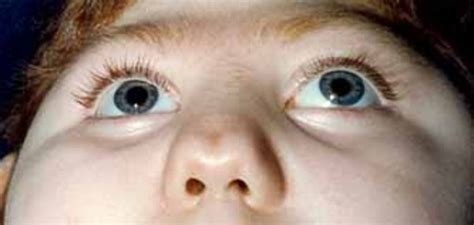 Hartsfield Syndrome Medlineplus Genetics