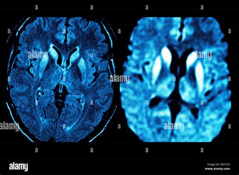 Creutzfeldt Jakob Disease Mri Stock Photo Royalty Free Image