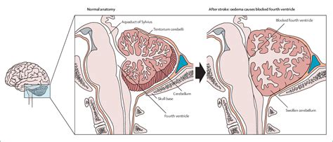 Figure 1 From Diagnosis And Initial Management Of Cerebellar Infarction Semantic Scholar