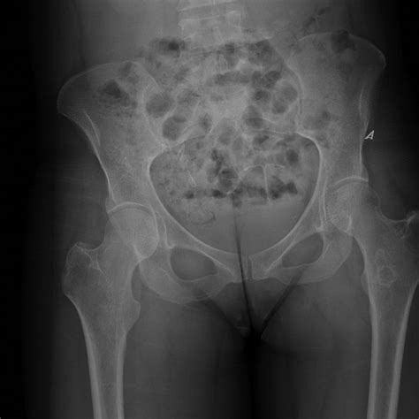 Ap Radiograph Of The Pelvis From The Same Day Demonstrating No