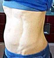 Tummy Tuck For Diastasis Recti Tummy Tuck Prices Photos Reviews