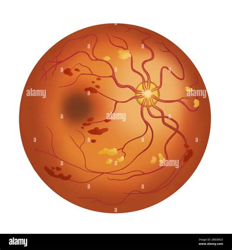 Retinal Hemorrhage Fotografías E Imágenes De Alta Resolución Alamy