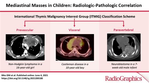 Mediastinal Masses In Children Radiologic Pathologic Correlation