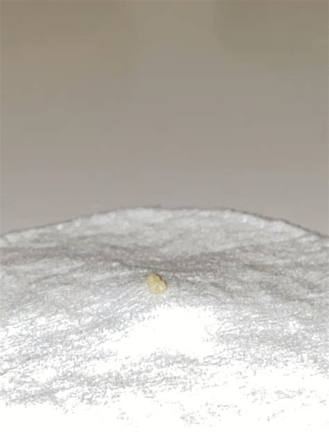 Tonsil Anxiety Rtonsilstones