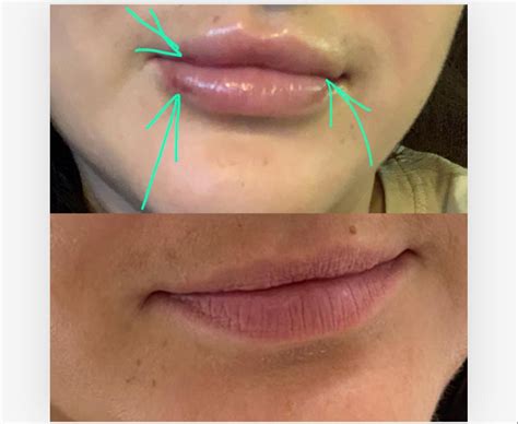 My Lip Filler Journey