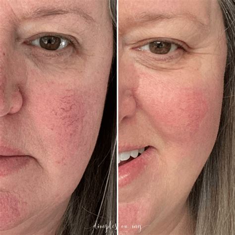 My Experience With Laser Treatment For Rosacea Including Before After Photos Artofit