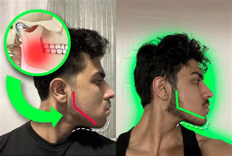 Jawline Sculpting Made Simple 16 Ways To Get Sculpted Jawline Mewing