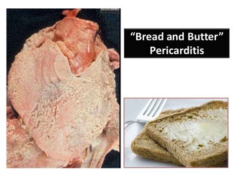 Rheumatic Heart Disease