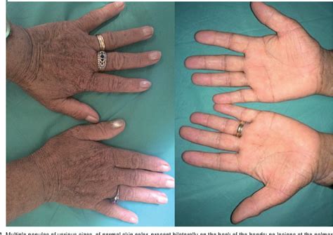 Figure From Late Onset Non Familial Acrokeratosis Verruciformis Of