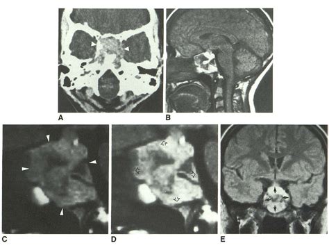 Figure 1 From Mr Imaging Of Mucoceles Of The Sphenoid Sinus Semantic