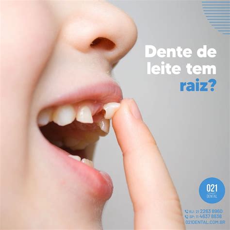 Dente De Leite Tem Raiz Dente de leite Saúde bucal Dentistas