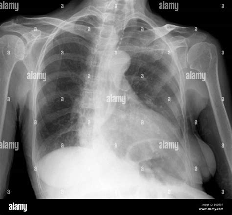 Enlarged Heart X Ray Of The Chest Of A 46 Year Old Patient With