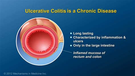 What Is Ulcerative Colitis Youtube