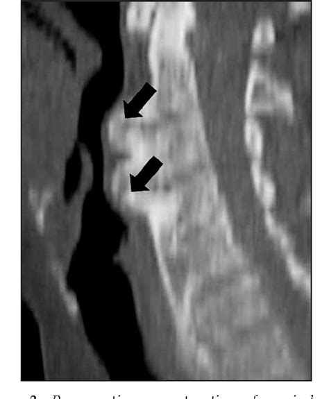 Figure 2 From Dysphagia Due To Diffuse Idiopathic Skeletal Hyperostosis Of The Cervical Spine