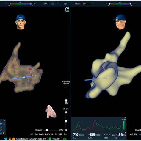 Anatomical Map With His Lead Using Kodex‐epd System Shows A Case Of Download Scientific