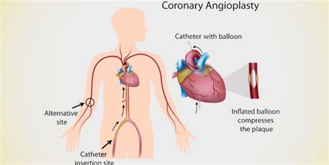 Risks of Angioplasty | Heart Health