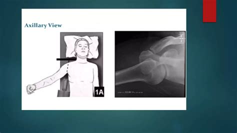 Recurrent Shoulder Dislocation And Management Ppt